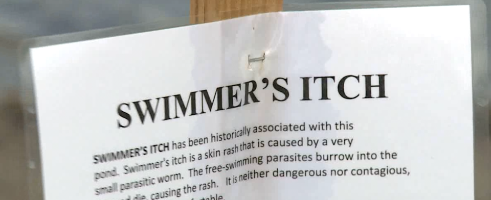 Do warnings about swimmer's itch keep you out of alpine lakes?