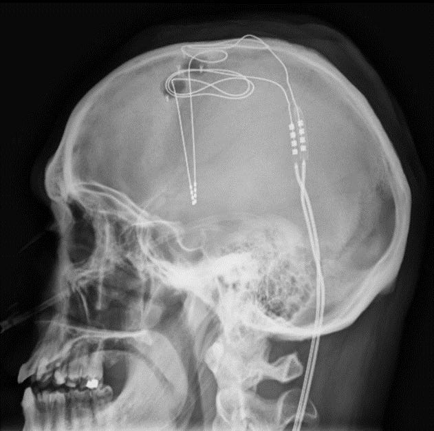 Could this brain implant help fight drug abuse?